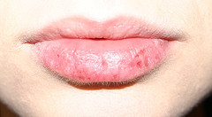 How Are Dry Lips And Vitamin Deficiency Related? | New Health Advisor